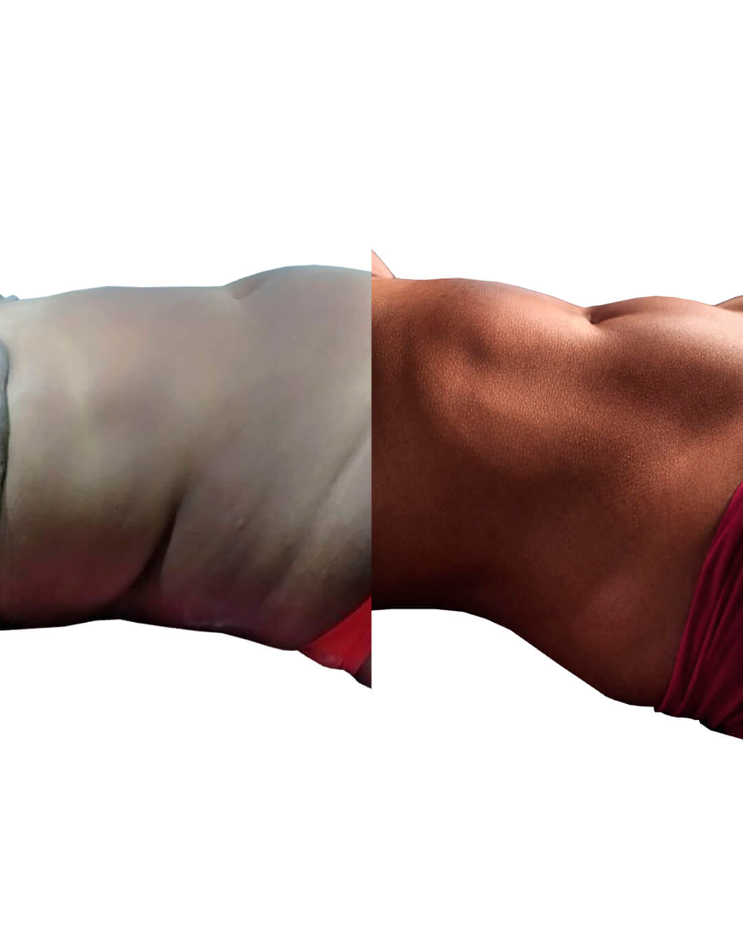 Resultado de antes e depois do tratamento Protocolo Exclusivo Elaine Veloso