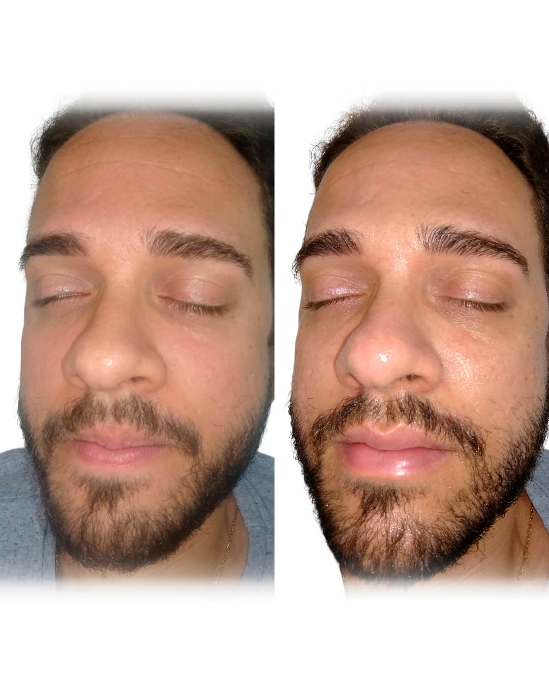 Resultado de antes e depois do tratamento Limpeza de Pele 3D