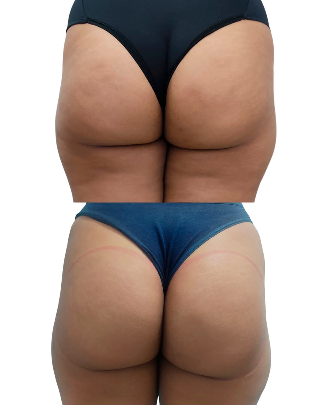 Resultado de antes e depois do tratamento Pump Up · Área Glútea