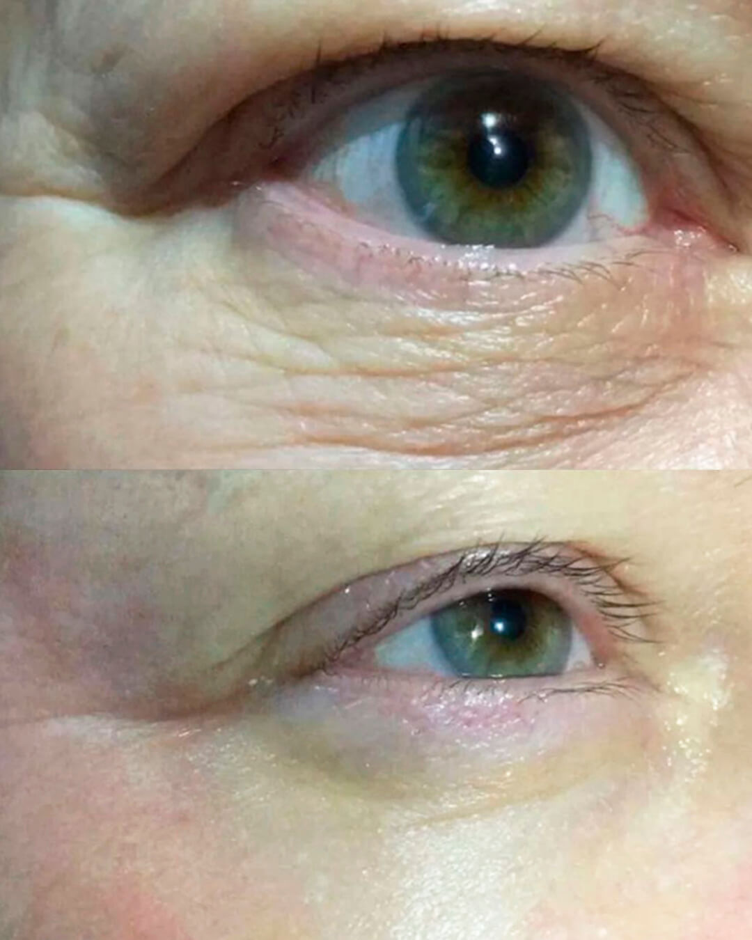 Resultado de antes e depois do tratamento Nano Hyaluron